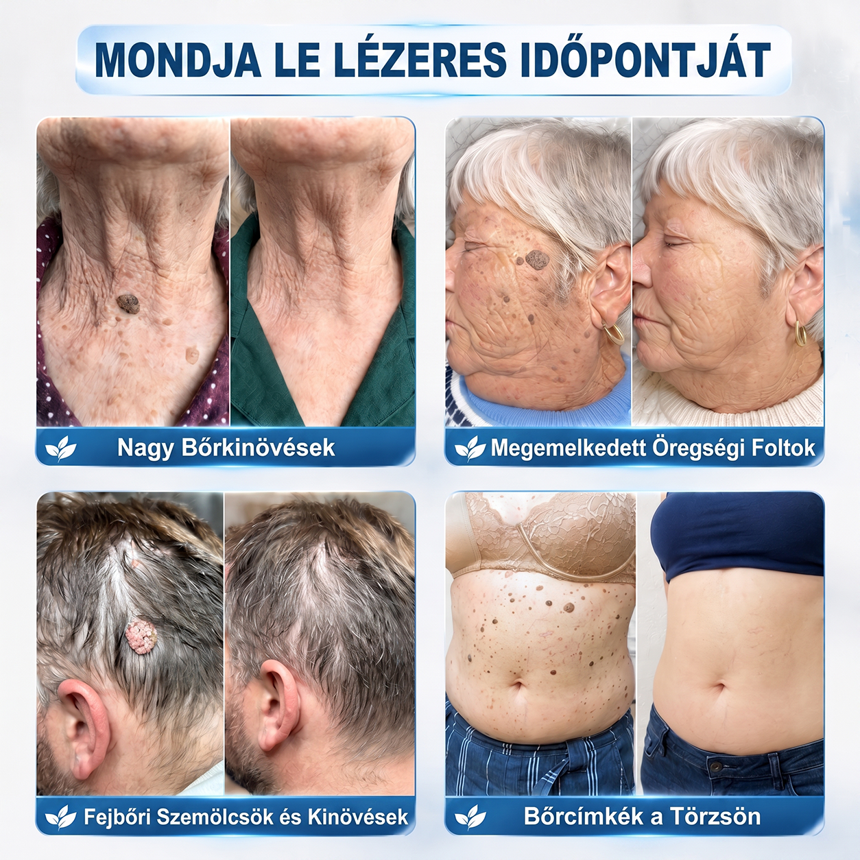 🚢Hivatalos Márkabolt | 🚢🚢 Hiskin® 7 napos Szemölcseltávolító Roll-on Ápoló Folyadék (Fájdalommentes rollerball technológia, hegek nélkül) 🐬