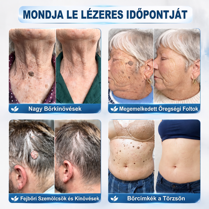 ✅Hivatalos Márkabolt | 🚢🚢 Hiskin® 7 napos Szemölcseltávolító Roll-on Ápoló Folyadék (Fájdalommentes rollerball technológia, hegek nélkül)