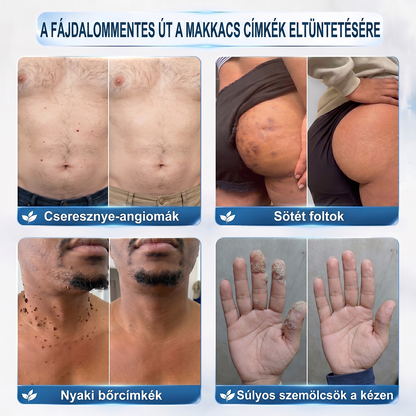 🚢Hivatalos Márkabolt | 🚢🚢 Hiskin® 7 napos Szemölcseltávolító Roll-on Ápoló Folyadék (Fájdalommentes rollerball technológia, hegek nélkül) 🐬