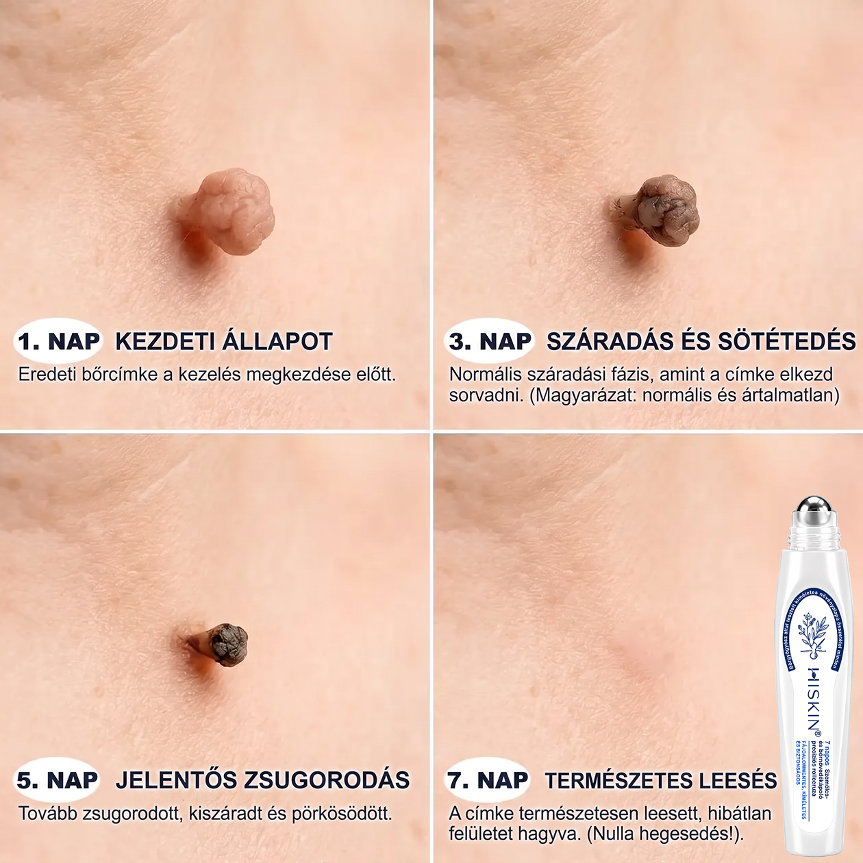 ✅Hivatalos Márkabolt | 🚢🚢 Hiskin® 7 napos Szemölcseltávolító Roll-on Ápoló Folyadék (Fájdalommentes rollerball technológia, hegek nélkül)
