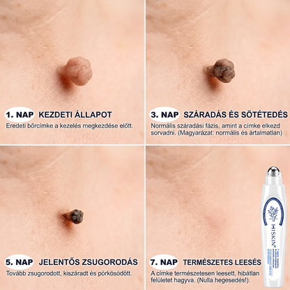 ✅Hivatalos Márkabolt | 🚢🚢 Hiskin® 7 napos Szemölcseltávolító Roll-on Ápoló Folyadék (Fájdalommentes rollerball technológia, hegek nélkül)